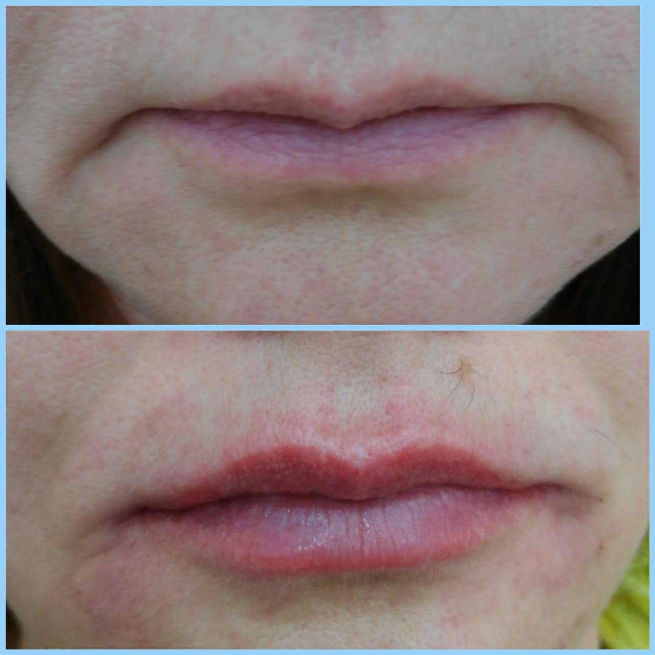 Приподнять уголки губ ботоксом фото до и после