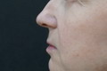 Коррекция носа