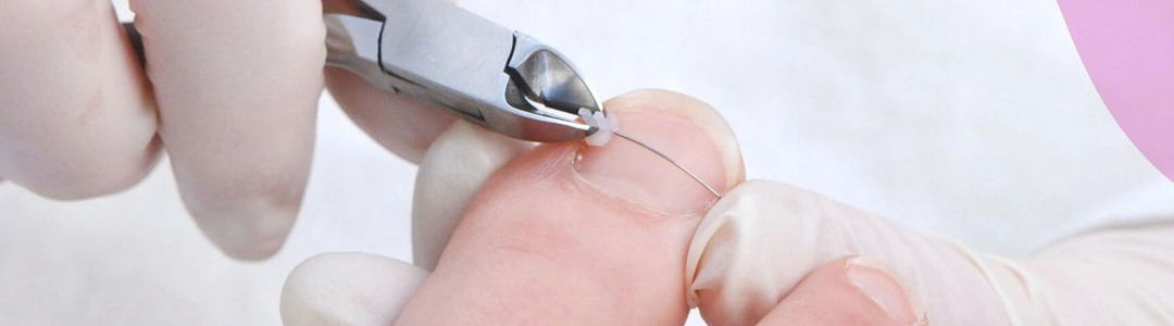 Коррекция вросшего ногтя титановой нитью